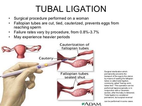 Discover the Benefits of Tubal Ligation Cauterization!